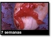 Fotografía de aborto - 7 semanas