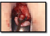 le forceps arrache une jambe et un pied du bébé le forceps arrache une jambe et un pied du bébé