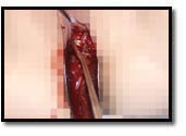 la curette tranchante extrait les intestins la curette tranchante extrait les intestins